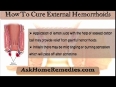 Cure External Hemorrhoids Without Surgery With Natural Remedies.