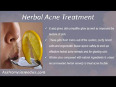 7-herbal acne treatment