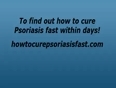 Top_psoriasis_home_treatment