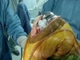 Knee Replacement Surgery Video