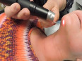 Dr william frazier facial smoothing and tightening with picosure laser