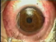 Eye_Surgery_for_Clear_Vision_-_Lasik_Eye_Vision___SoftTouchLenses