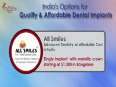 Top 6 places for affordable dental implants in india